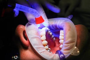 Разгледайте Dental Implants 4