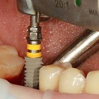 Оферти за естетична стоматология 36 от MedicalDent Оферти за естетична стоматология 36