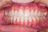 Най-добрите оферти за коронка на зъб цена 5 от The Smile Company Най-добрите оферти за коронка на зъб цена 5
