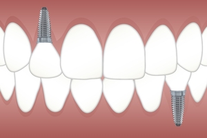 Изключително качествени зъбни импланти цени 35
