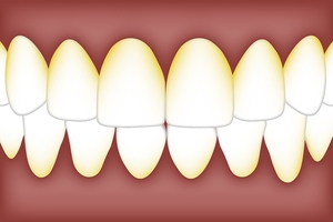 Типове зъбни импланти цени 36