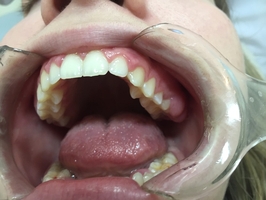 Изберете нашите Invisalign 23 - DsDent Изберете нашите Invisalign 23