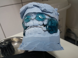 Най-добрите Invisalign 26 - DsDent Най-добрите Invisalign 26