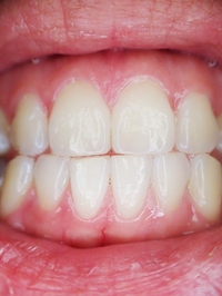 Най-добрите Invisalign 38 - DsDent Най-добрите Invisalign 38