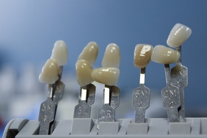 Видове Invisalign 5 - DsDent Видове Invisalign 5