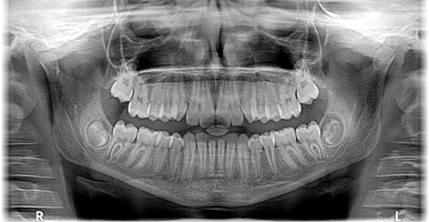 Изберете нашите Invisalign 9 - DsDent Изберете нашите Invisalign 9