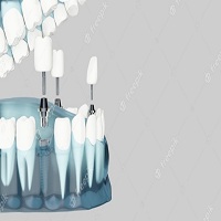 зъбни импланти цена - 16988 новини | Дентимплант зъбни импланти цена - 90434 новини