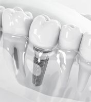 мезотерапия Варна - 46708 снимки | Dental Club мезотерапия Варна - 69240 снимки