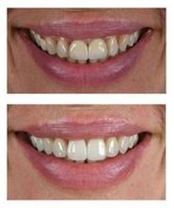 бруксизъм - 14975 промоции | Supreme Dental бруксизъм - 39348 промоции