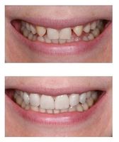 изтрити зъби - 24483 клиенти | Supreme Dental изтрити зъби - 82018 клиенти