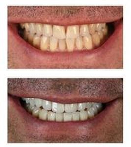 скърцане със зъби - 72122 снимки | Supreme Dental скърцане със зъби - 16255 снимки