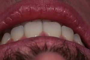 зъбни импланти - 75610 разновидности