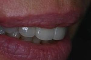 зъбни импланти - 79816 новини